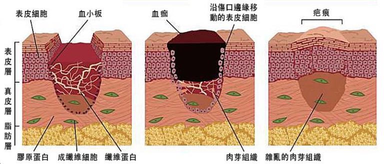 【傷口護理】認識及處理3大傷口種類 | 「老友宅醫」網站