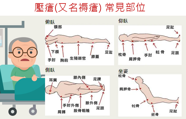 長期臥床必有壓瘡 | 「老友宅醫」網站