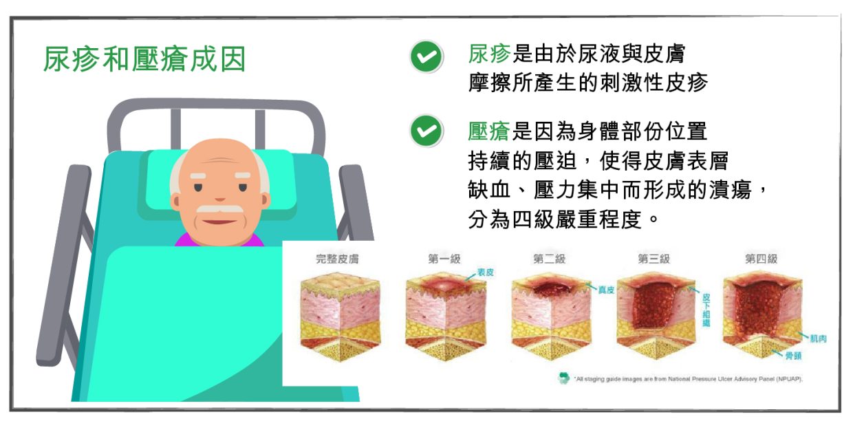 【傷口護理】 如何分別尿疹與壓瘡 | 「老友宅醫」網站