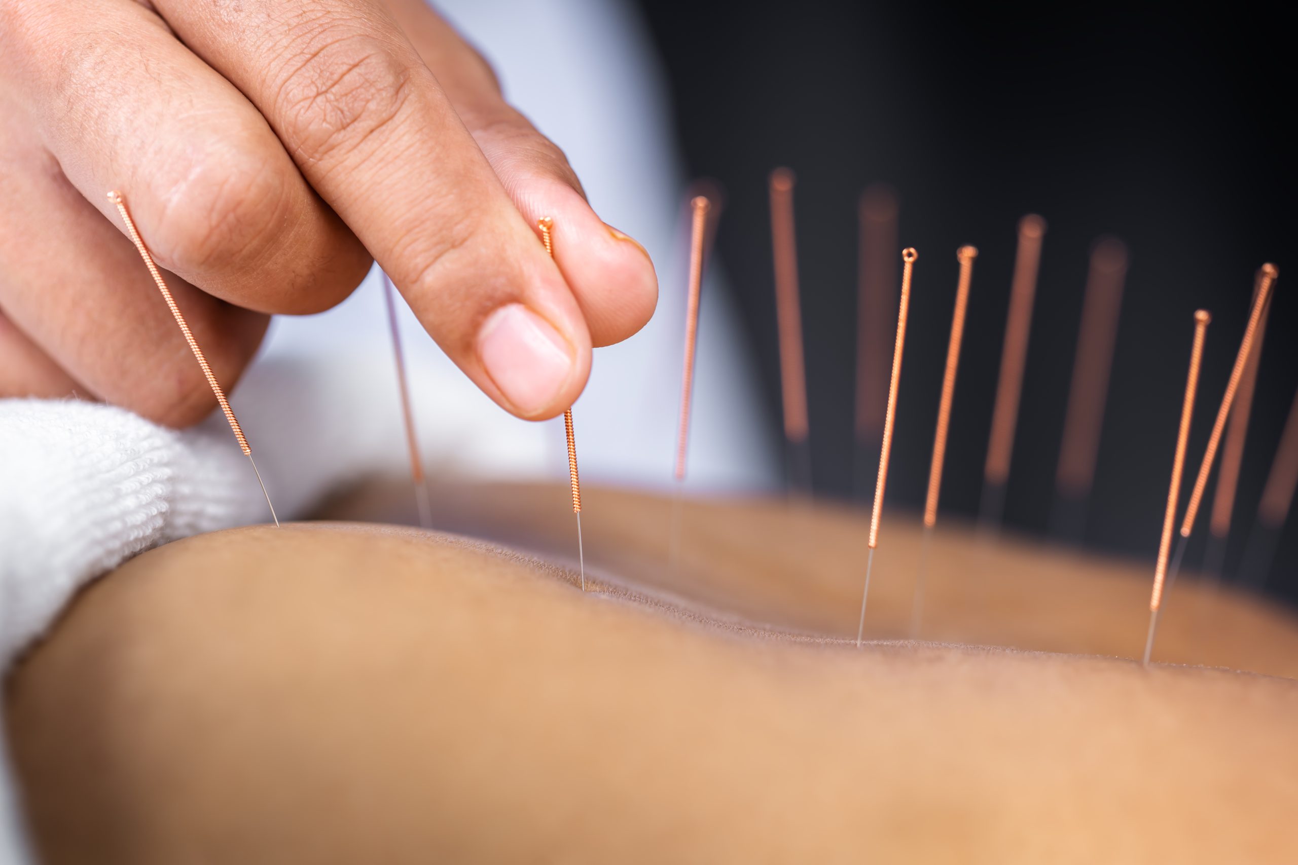 Close-up of senior female back with steel needles during procedure of the acupuncture therapy